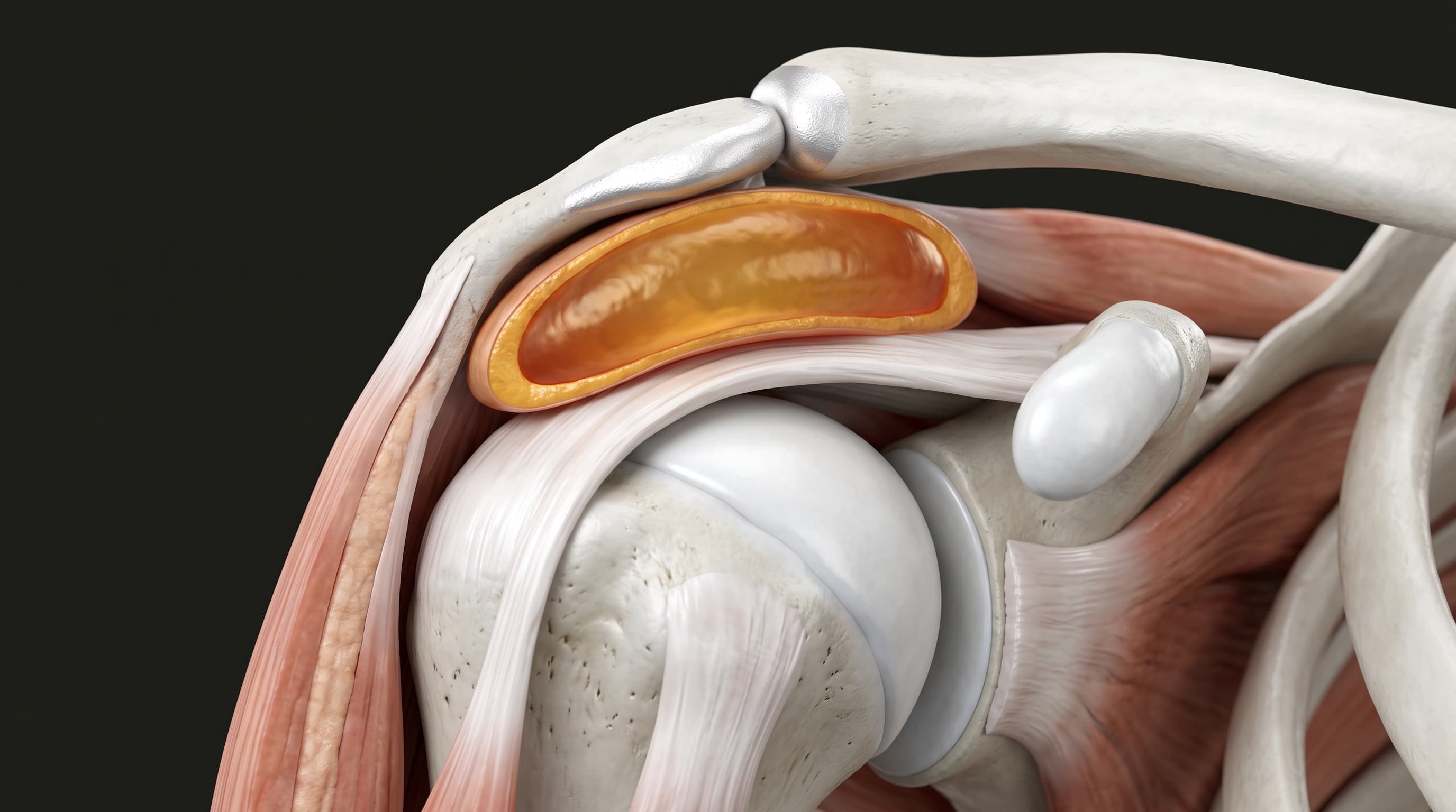 Dolor de Hombro y Tendinitis Calcificante
