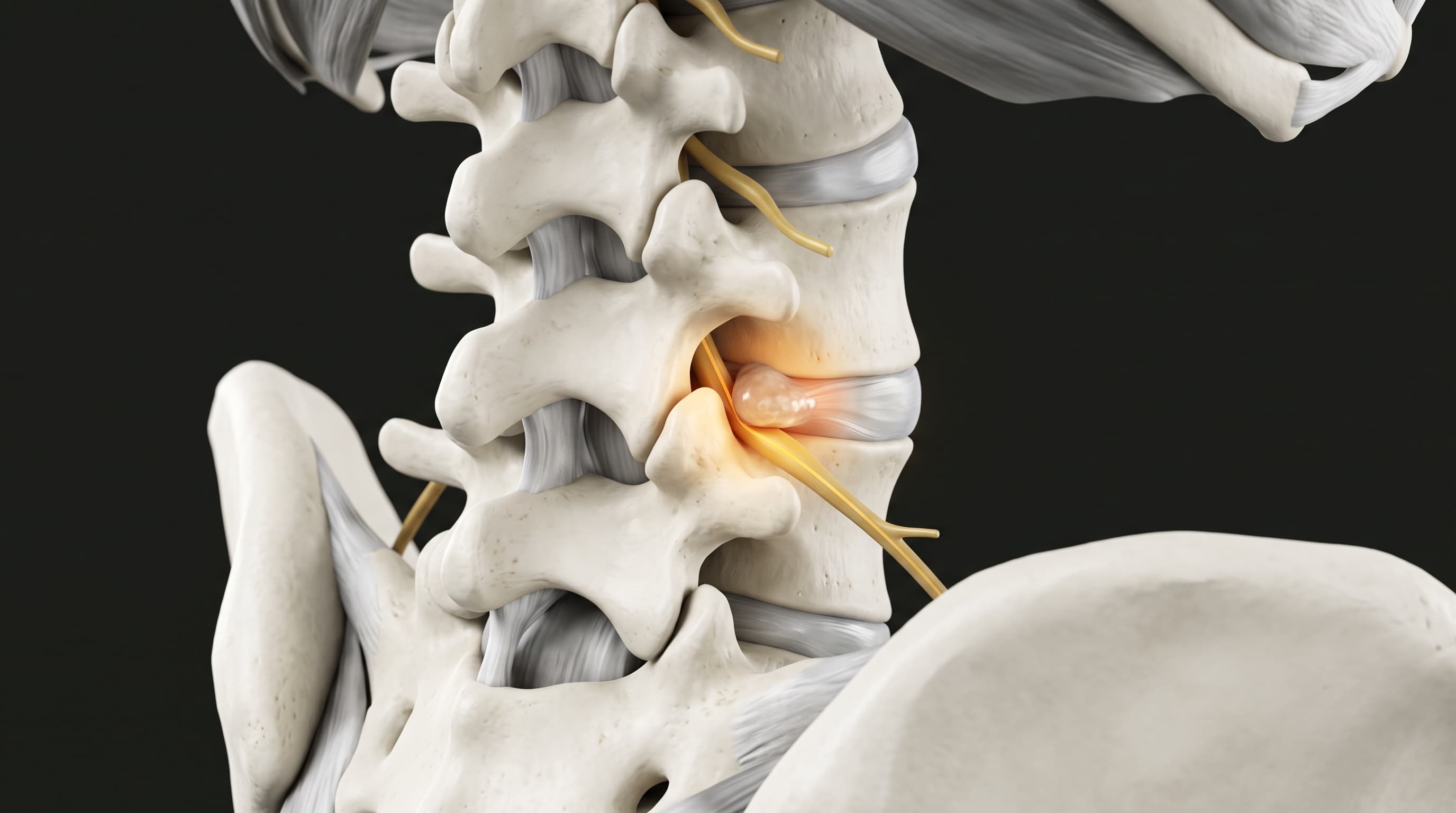 Pinzamiento Femoroacetabular y Hernia Discal Lumbar