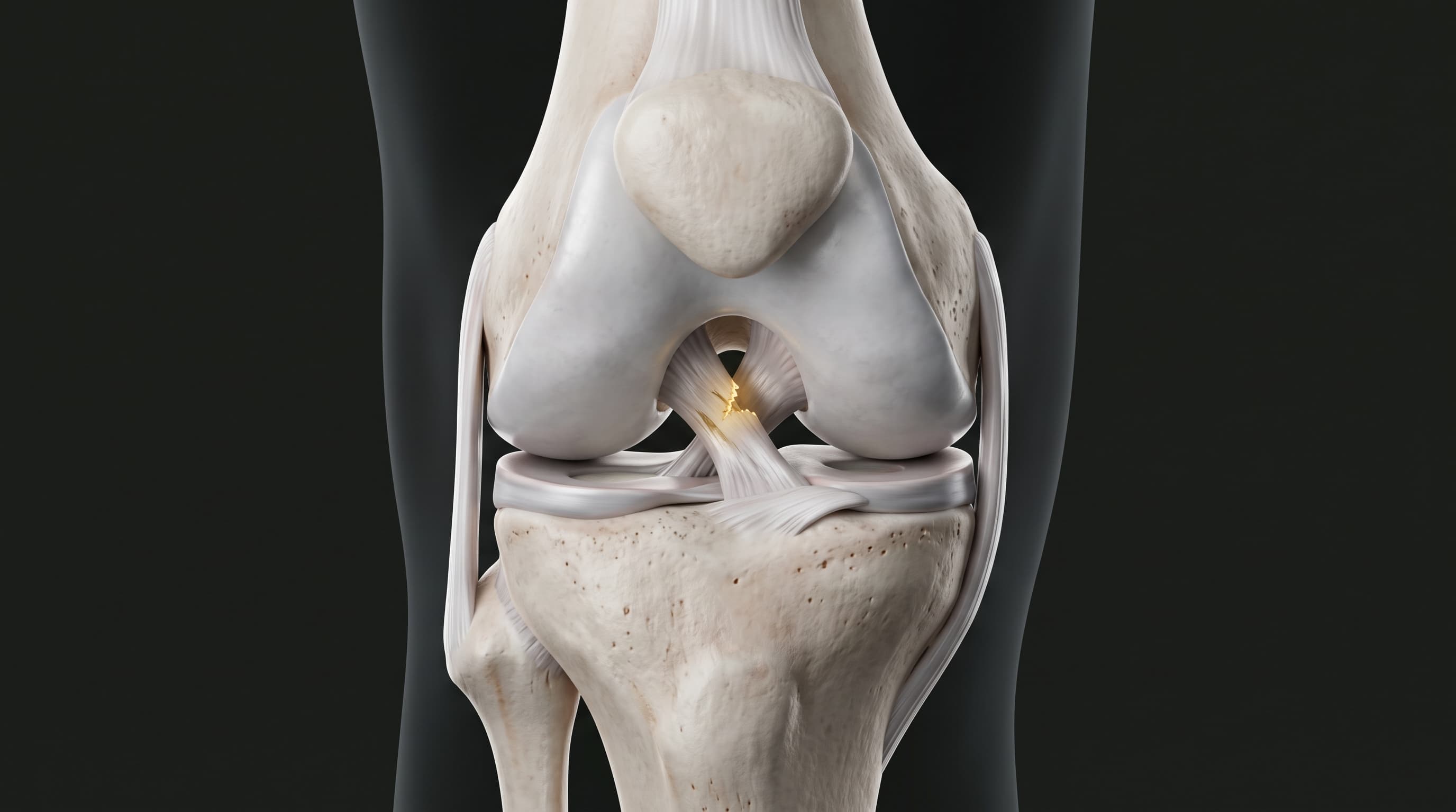 Lesiones de Ligamentos de la Rodilla (LCA y LCP)