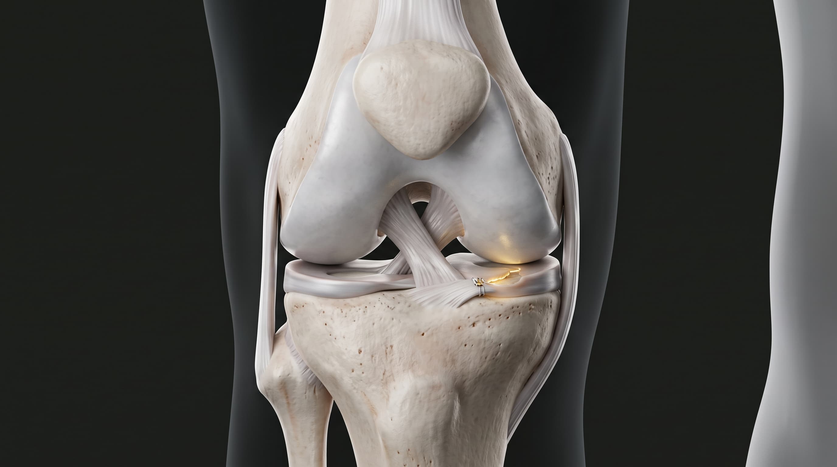 Lesiones de los Meniscos de la Rodilla