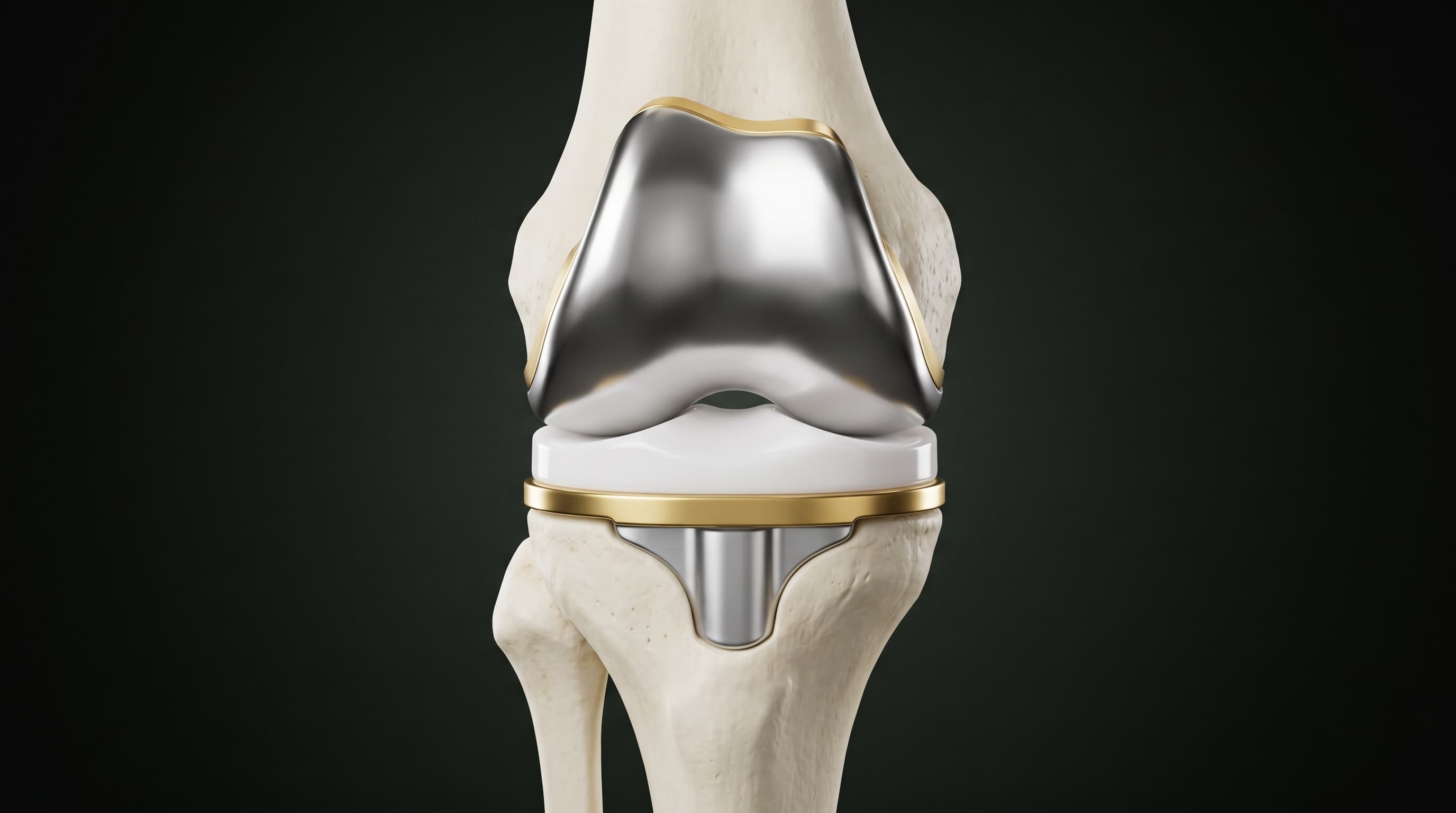 Prótesis y Reemplazo Total de Rodilla (Artroplastia de Rodilla)